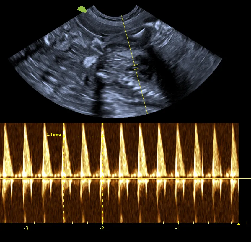 Ecografía Doppler del latido fetal con la frecuencia cardíaca